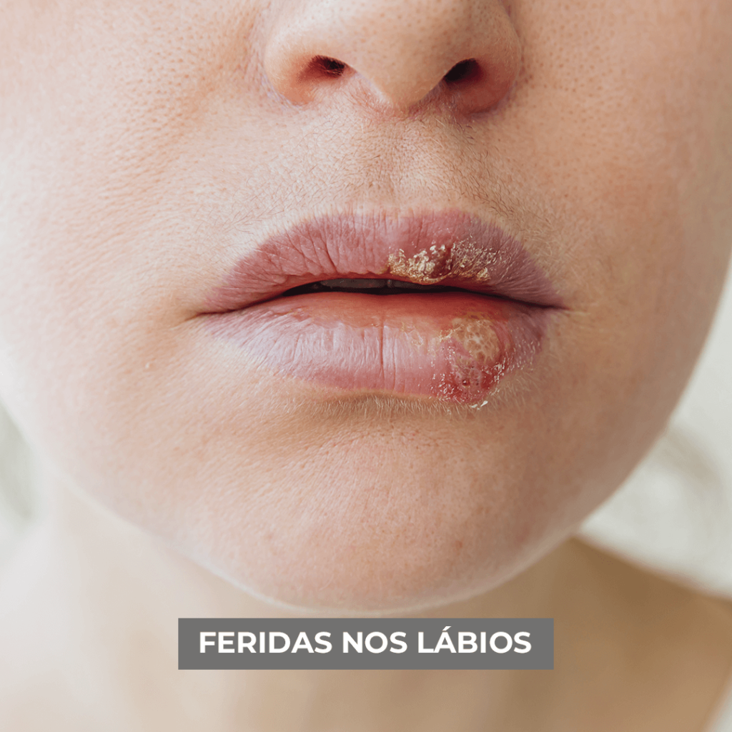 FERIDA